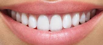 Is Teeth Whitening Safe